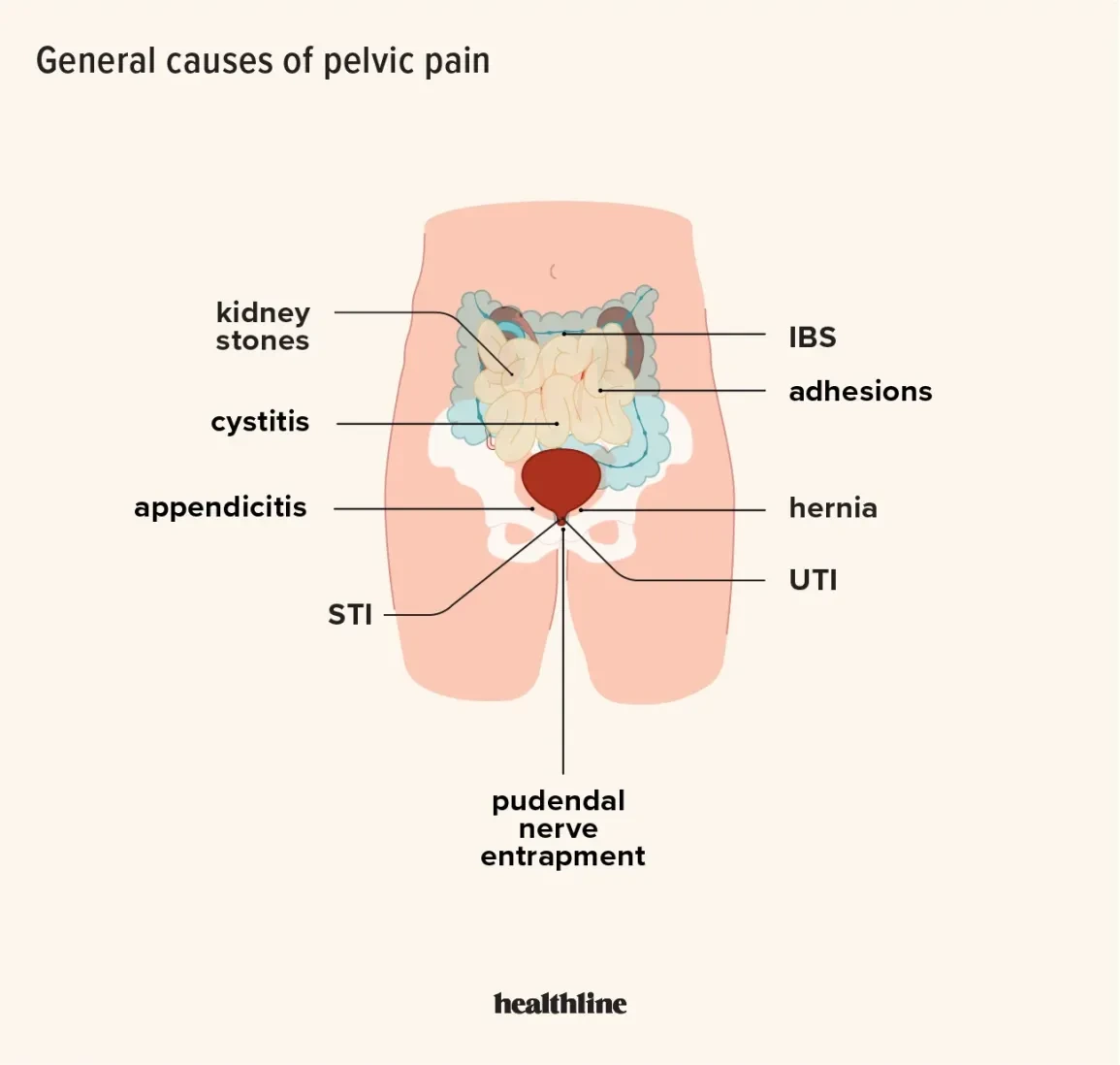 Can Fibroids Cause Infertility?