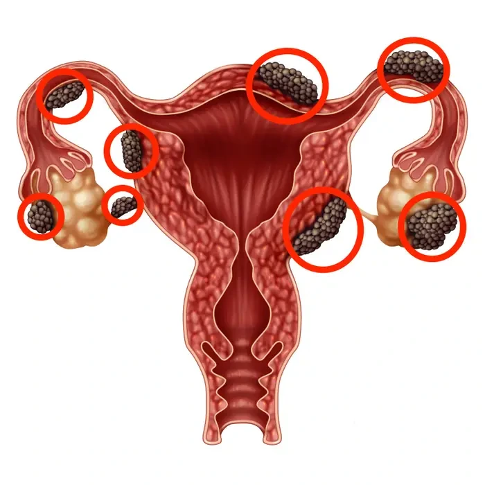 What Are the Common Symptoms of Endometriosis?