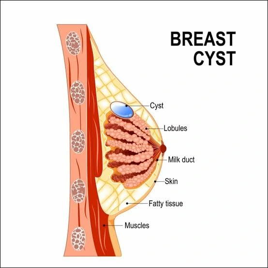 Can Breast Cysts Cause Pain?