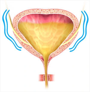 What Is Urinary Leakage in Women?